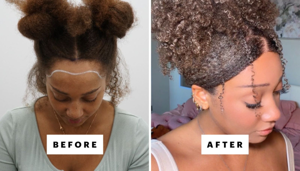Nychy Eyanna before and after receiving a hair transplant in Istanbul Turkey.
