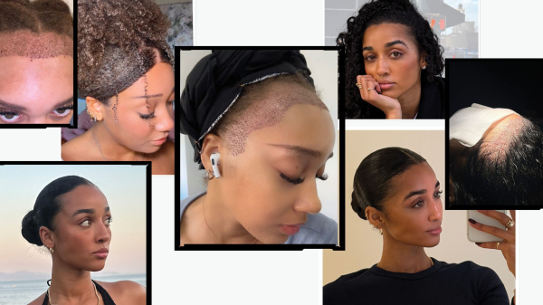 More Women Are Getting Hair Transplants in Turkey